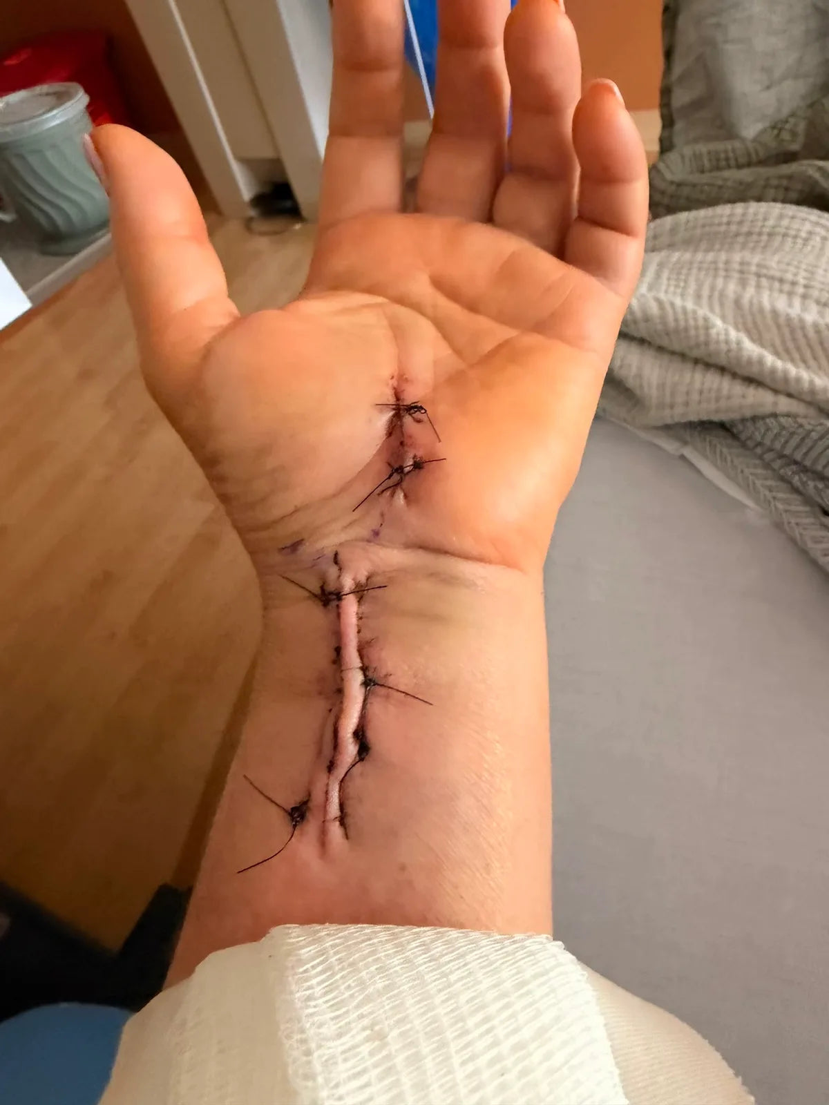 Post-surgery wrist showing a healing carpal tunnel release incision